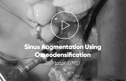 Osseodensification implantsinus augmentation