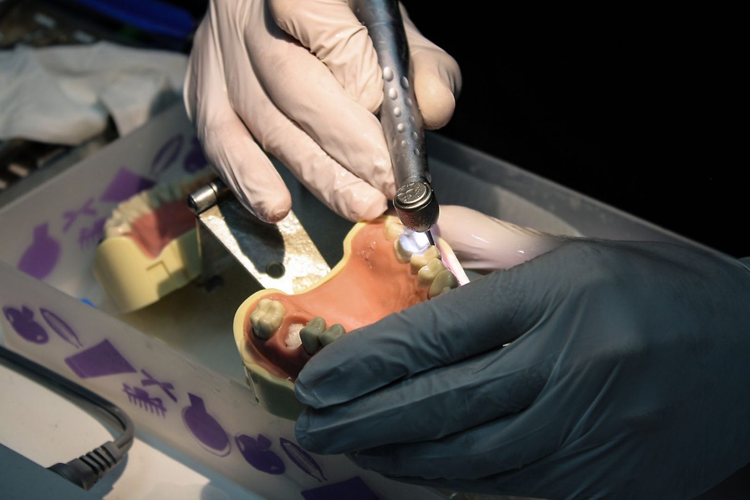 Find Onlays Near Me for Affordable Dental Restoration