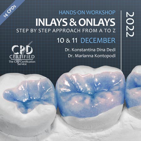 Inlays Onlays Dental Workshop 2022