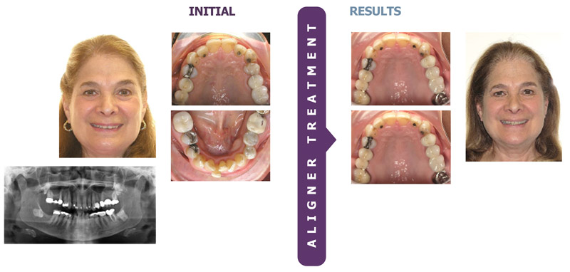 The Successful Use of Clear Aligners for Total Treatment