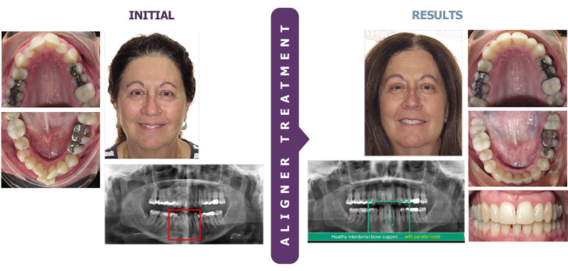 The Successful Use of Clear Aligners for Total Treatment
