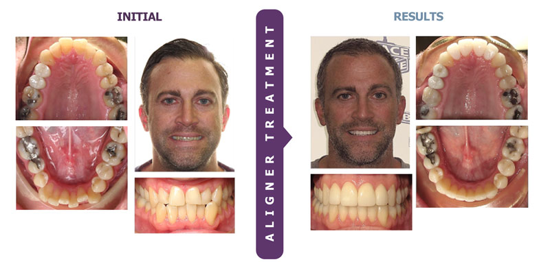 The Successful Use of Clear Aligners for Total Treatment