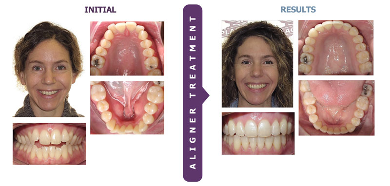 The Successful Use of Clear Aligners for Total Treatment