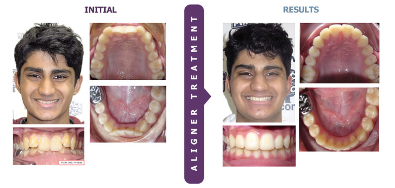 The Successful Use of Clear Aligners for Total Treatment