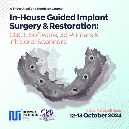 In-House Guided Implant Surgery & Restoration: CBCT, Software, 3d Printers & Intraoral Scanners