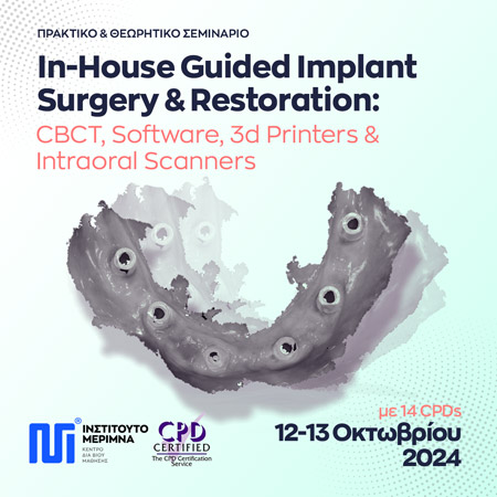 In-House Guided Implant Surgery and Restoration: CBCT, Software, 3d Printers and Intraoral Scanners
